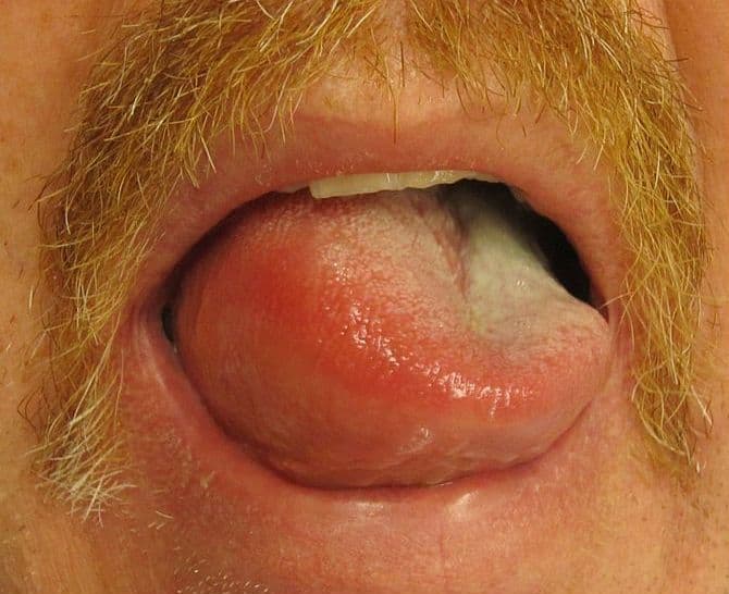 Obrzęk Quinckego (obrzęk naczynioruchowy) – przyczyny, objawy, leczenie