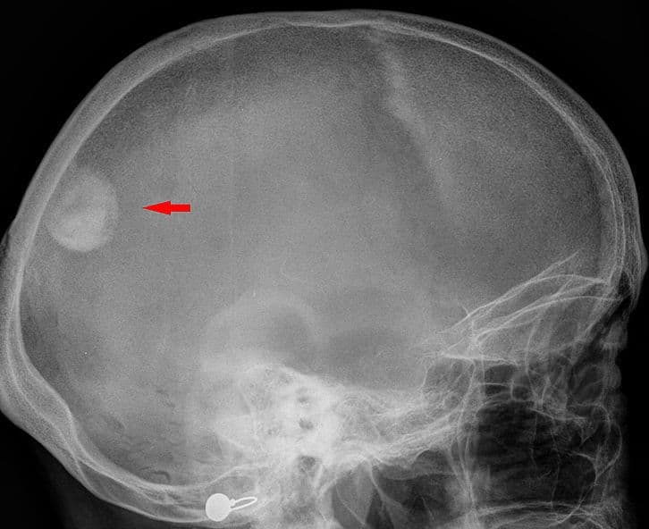 Oponiak mózgu (meningioma) – objawy, przyczyny, powikłania, leczenie, rokowania