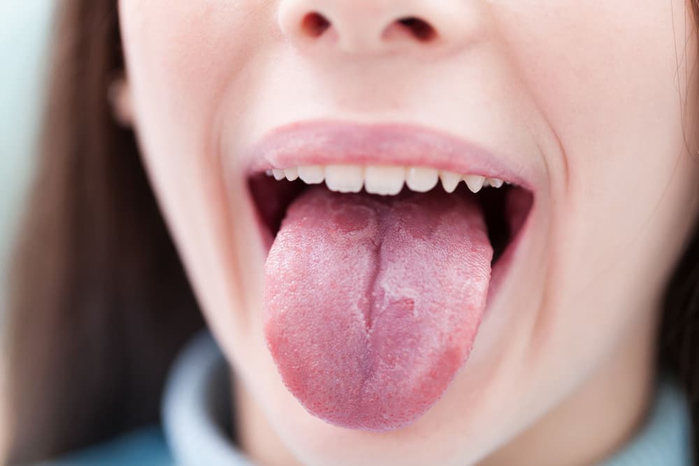 Drętwienie języka – co oznacza mrowienie języka?