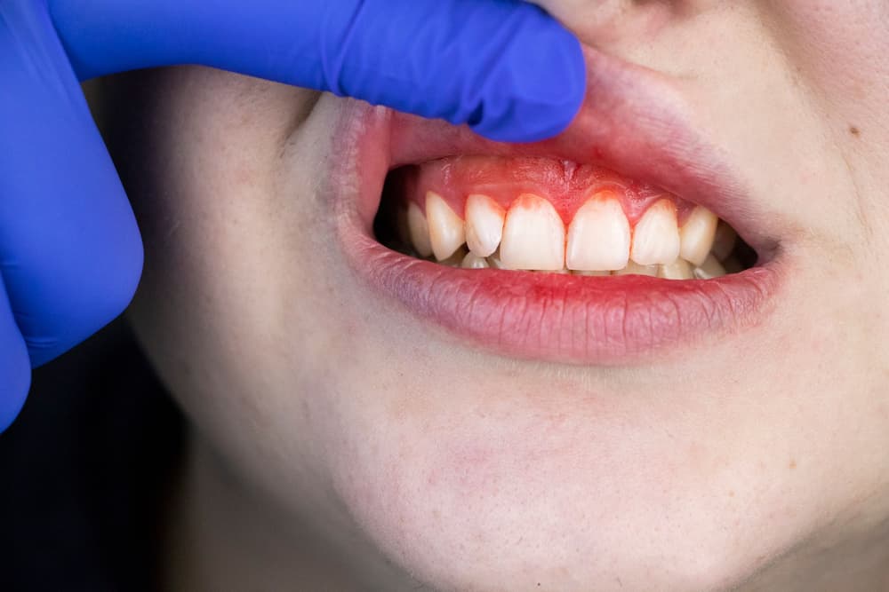 Paradontoza – przyczyny, objawy, diagnostyka, leczenie