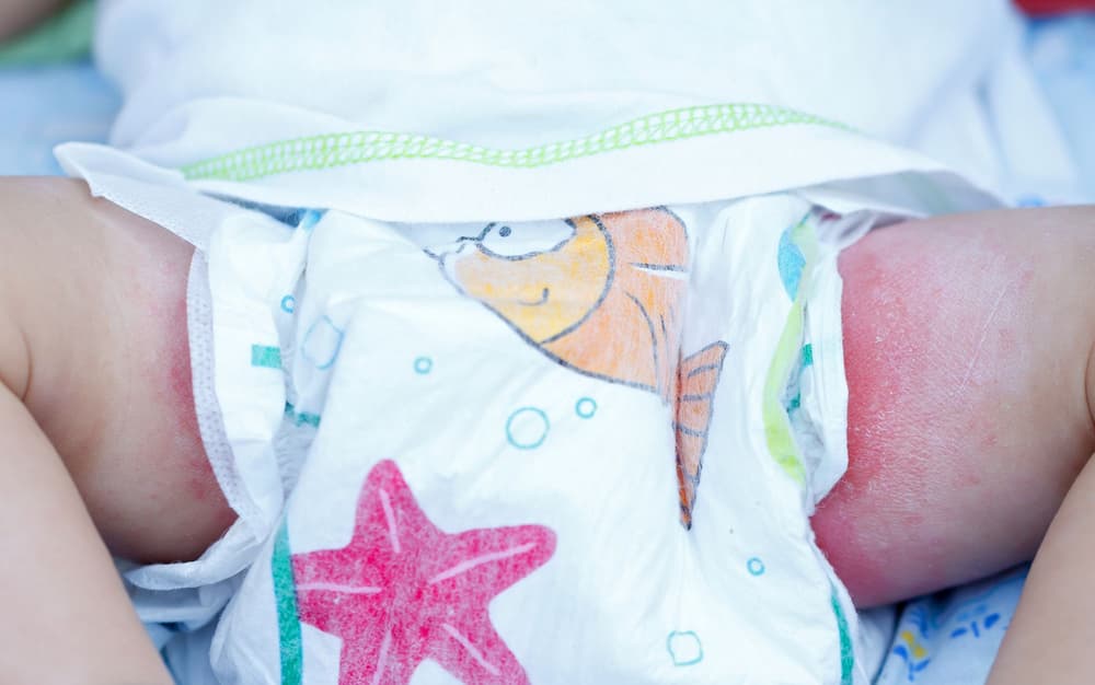 Pieluszkowe zapalenie skóry – przyczyny, objawy, diagnostyka, leczenie, domowe sposoby