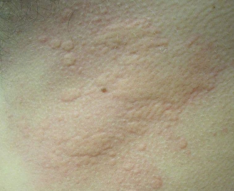 Pokrzywka alergiczna – przyczyny, objawy, jak wygląda, leki, leczenie domowe
