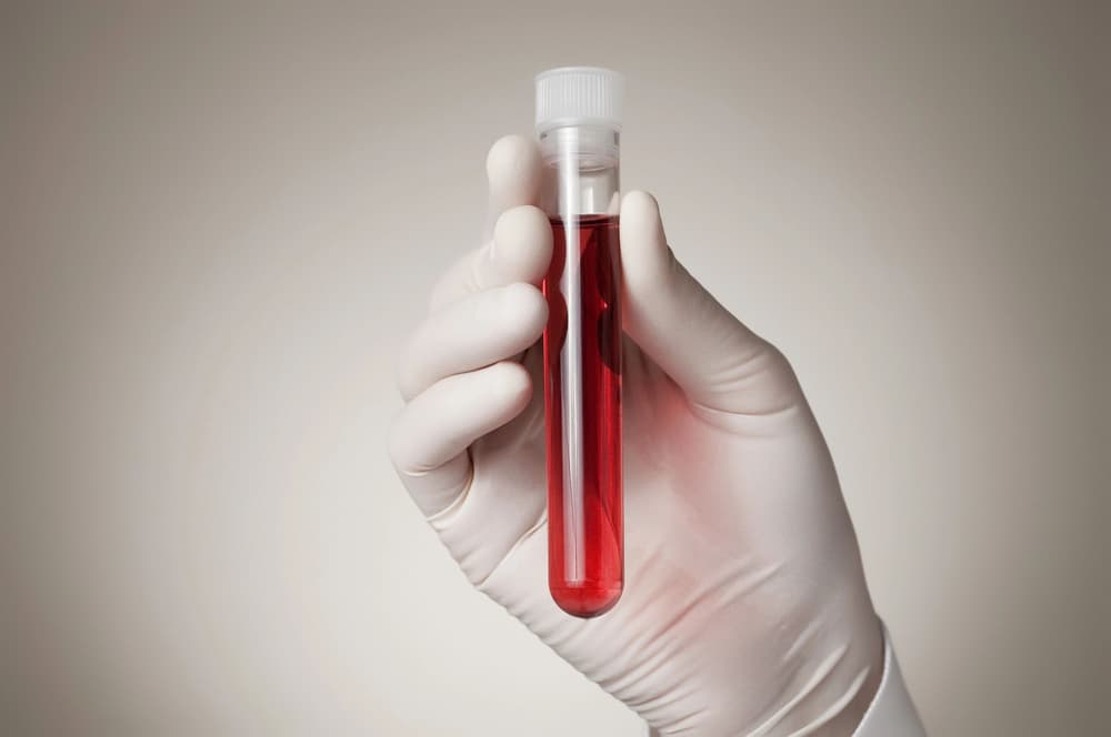 Poliglobulia – co to jest? Przyczyny, objawy, diagnostyka, leczenie