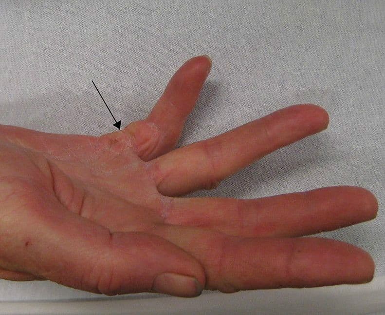 Przykurcz Dupuytrena – przyczyny, objawy, leczenie, operacja, rehabilitacja, ćwiczenia, powikłania