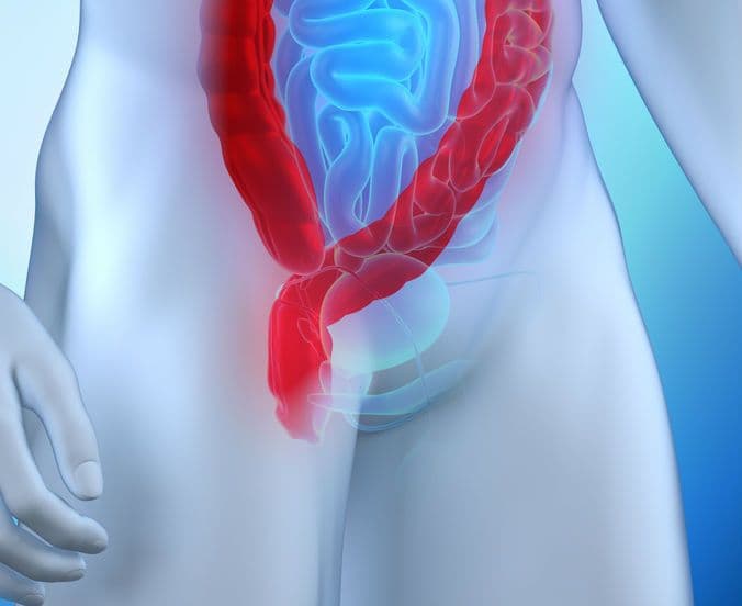 Rak odbytnicy – przyczyny, objawy, leczenie