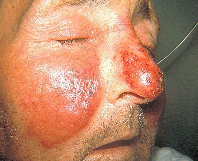 Róża – przyczyny, objawy, leczenie choroby skóry u dzieci i dorosłych