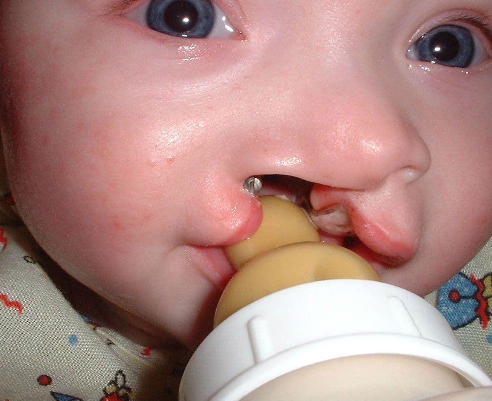 Rozszczep wargi i podniebienia – przyczyny, objawy, leczenie