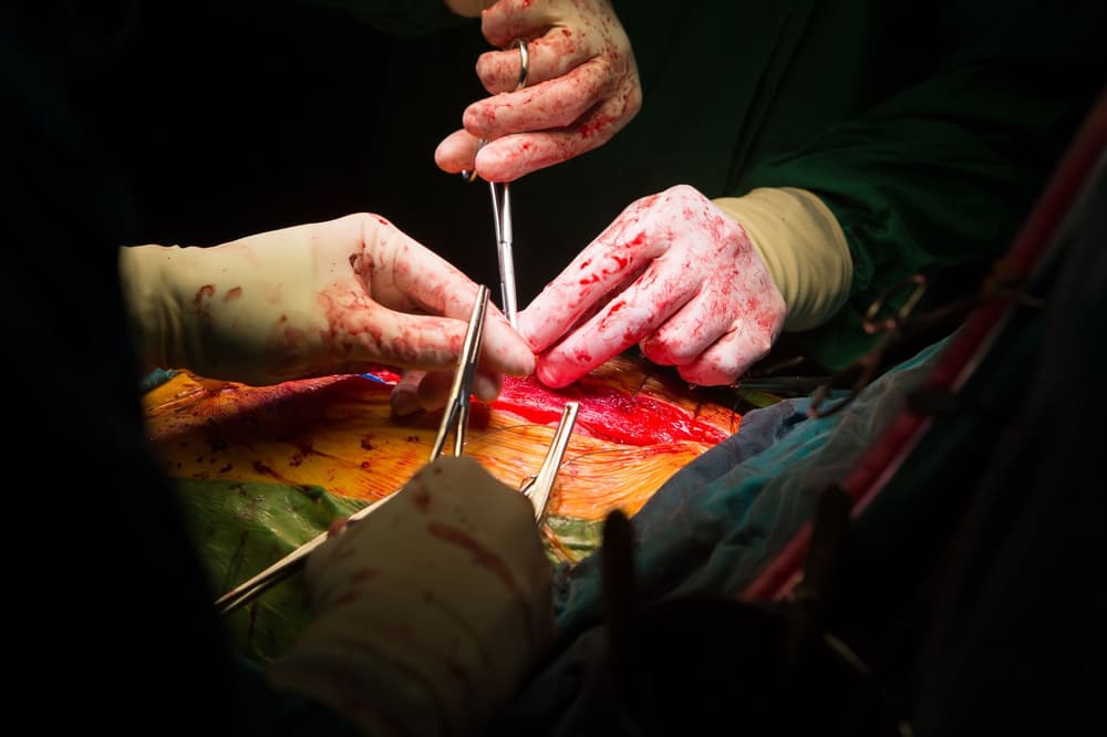 Sternotomia (przecięcie mostka) – powikłania i rehabilitacja po operacji