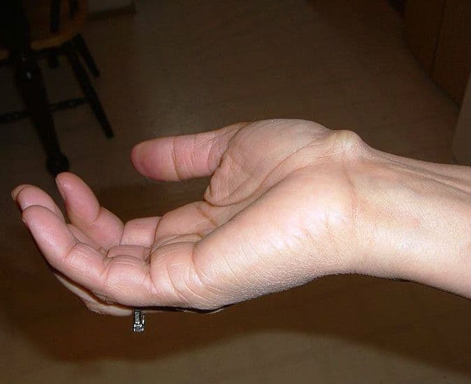 Torbiel galaretowata (ganglion) – przyczyny, objawy, leczenie