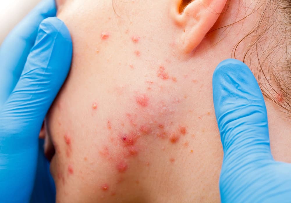 Trądzik grudkowy – przyczyny, objawy, diagnostyka, leczenie
