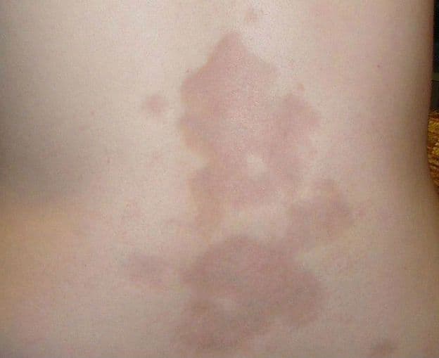 Twardzina ograniczona – przyczyny, objawy, diagnostyka, leczenie