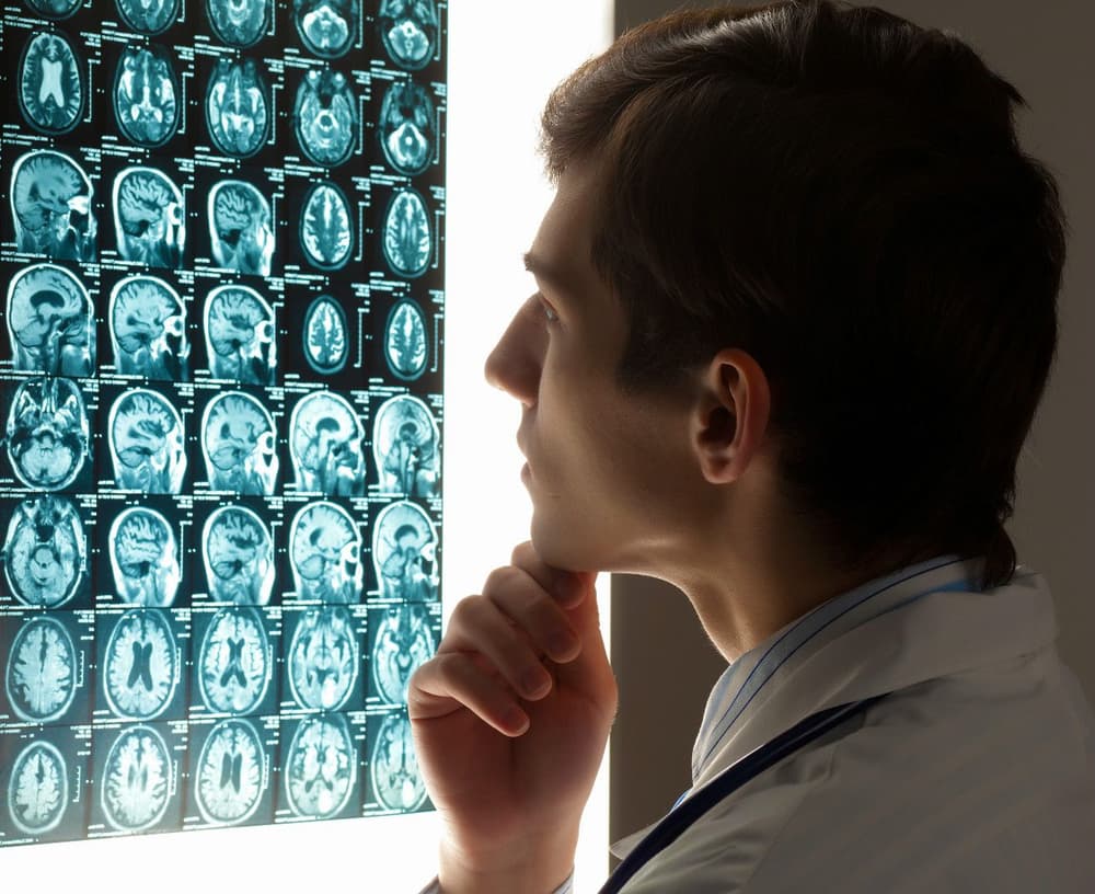 Krwotok podpajęczynówkowy – przyczyny, objawy, diagnostyka, leczenie, rokowania