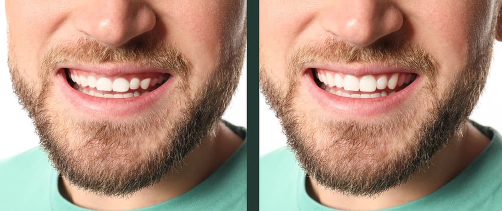 Gummy smile (uśmiech dziąsłowy) – przyczyny, objawy, leczenie