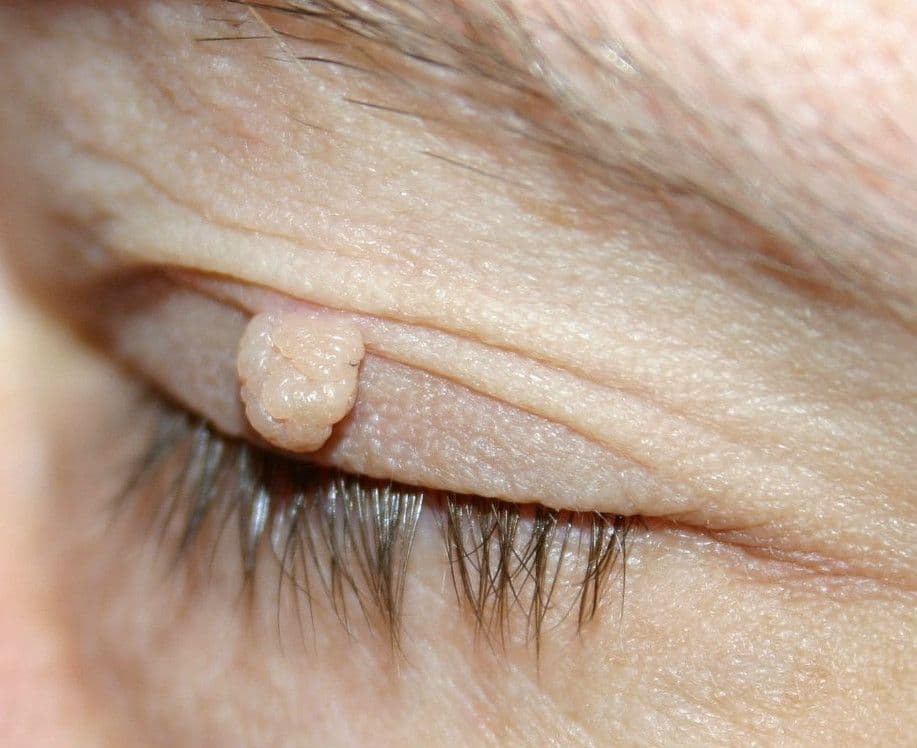 Włókniak (fibroma) – co to jest?