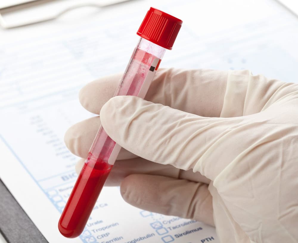 Wyniki cholesterolu – jakie są prawidłowe normy cholesterolu (TC, LDL, HDL, TG)?