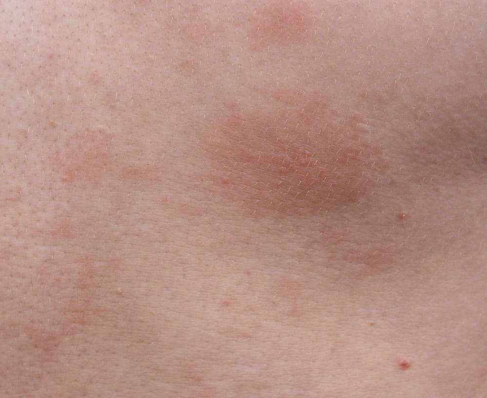Wyprysk pieniążkowaty – przyczyny, objawy, diagnostyka, leczenie