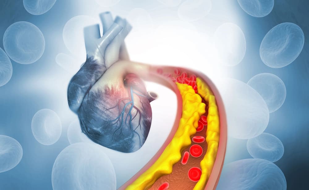grafika przedstawiająca wypełnioną cholesterolem tętnicę