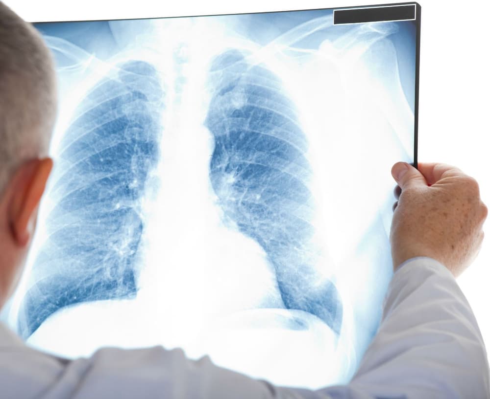 Zachłystowe zapalenie płuc – przyczyny, objawy, diagnostyka, leczenie