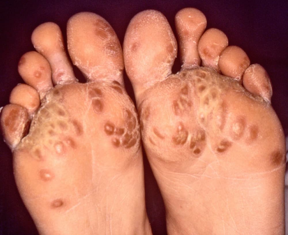 Zespół Reitera – przyczyny, objawy, badania, leczenie, rehabilitacja