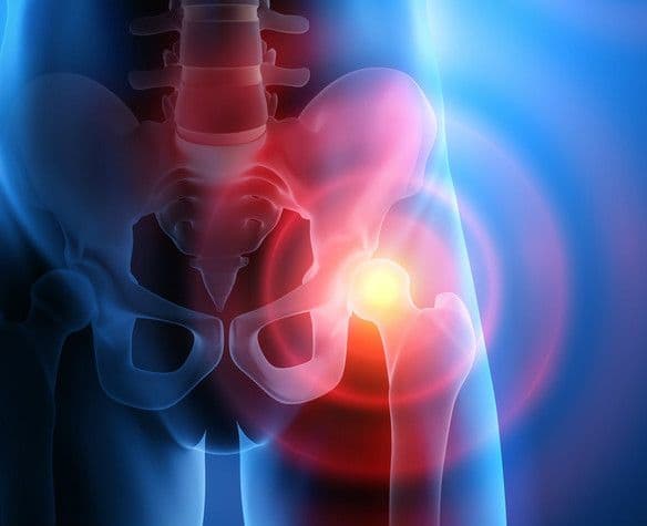 Złamania osteoporotyczne – najczęstsze złamania kości w osteoporozie