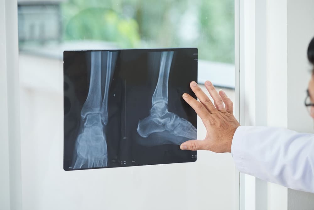 Złamanie awulsyjne – co to jest, jak długo trwa leczenie i rehabilitacja?