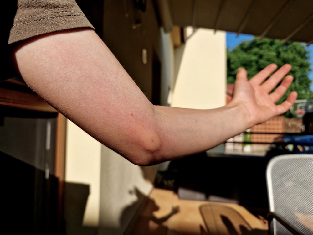 mężczyzna ze spuchniętą po użądleniu ręką mężczyzna ze spuchniętą po użądleniu ręką