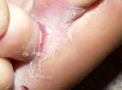 Grzybica międzypalcowa – jak leczyć grzybicę stóp między palcami? Grzybica międzypalcowa – jak leczyć grzybicę stóp między palcami?