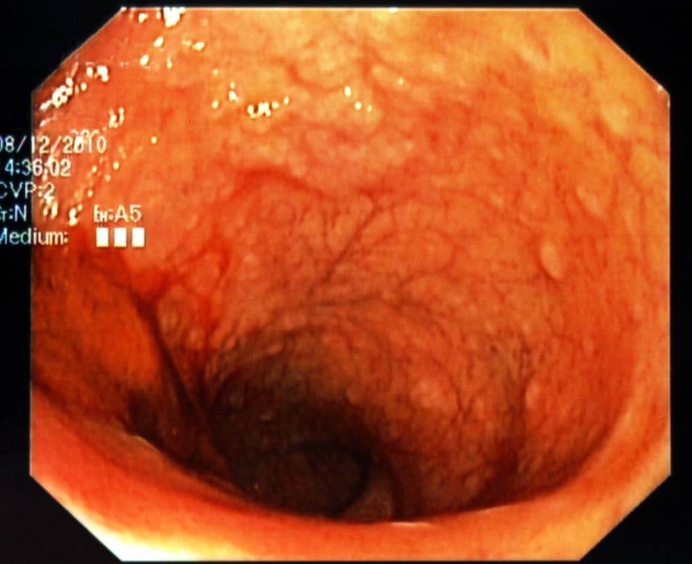 Jak wykryć raka jelita grubego? Badania na raka jelita grubego Jak wykryć raka jelita grubego? Badania na raka jelita grubego