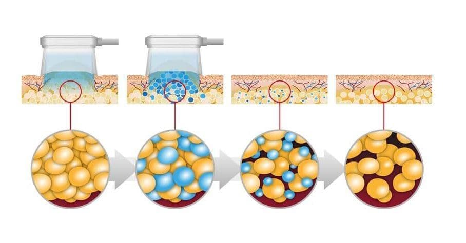 Przebieg zabiegu kriolipolizy Przebieg zabiegu kriolipolizy