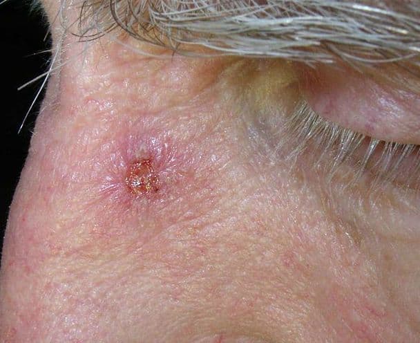 Nowotwory skóry – rak podstawnokomórkowy i kolczystokomórkowy Nowotwory skóry – rak podstawnokomórkowy i kolczystokomórkowy