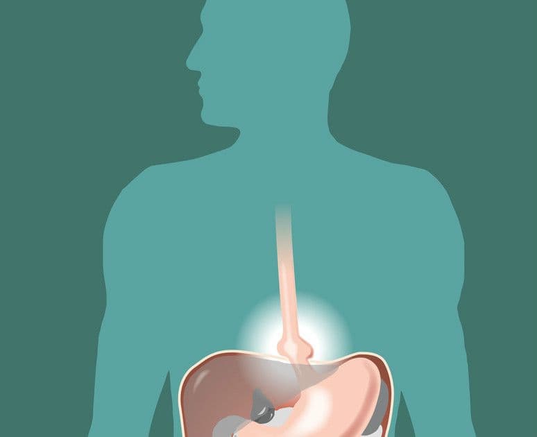 Przepuklina rozworu przełykowego przepony – objawy i leczenie Przepuklina rozworu przełykowego przepony – objawy i leczenie