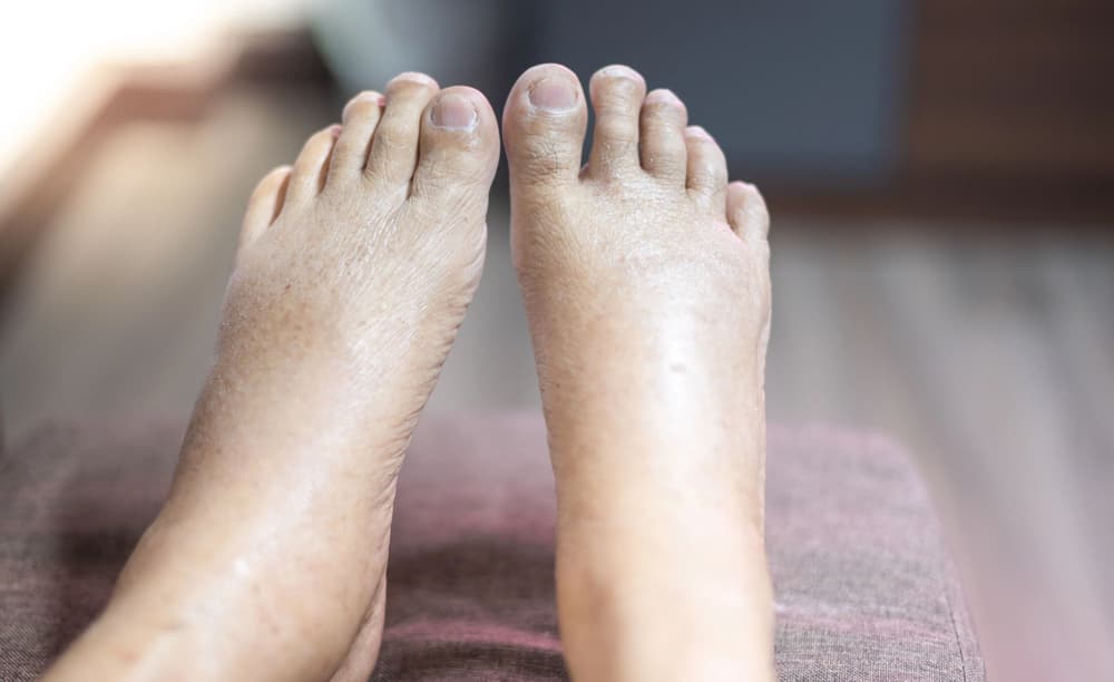 Spuchnięte stopy – przyczyny i sposoby na opuchnięte stopy? Spuchnięte stopy – przyczyny i sposoby na opuchnięte stopy?