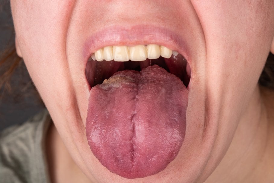 rak jamy ustnej