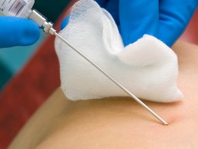 Biopsja płuc – jak wygląda, wskazania, przebieg, powikłania