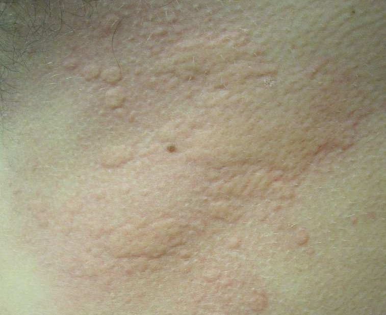 Pokrzywka Alergiczna Przyczyny Objawy Jak Wyglada Leki Leczenie Domowe Wylecz To