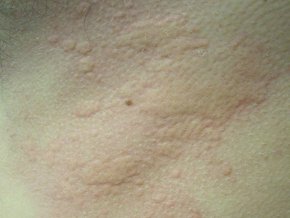 Pokrzywka alergiczna – przyczyny, objawy, jak wygląda, leki, leczenie domowe