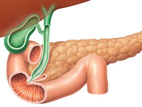 Insulinoma (wyspiak trzustki) – objawy, badania, leczenie, rokowania