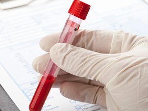 Wyniki cholesterolu – jakie są prawidłowe normy cholesterolu (TC, LDL, HDL, TG)?