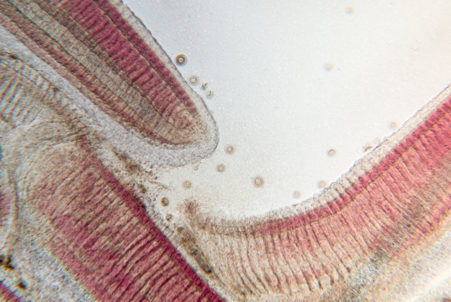 Schistosomatoza – objawy