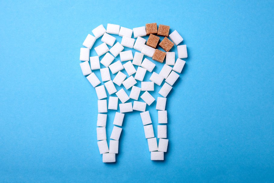 Próchnica zębów – przyczyny, rodzaje, etapy, jak wygląda, leczenie, zapobieganie