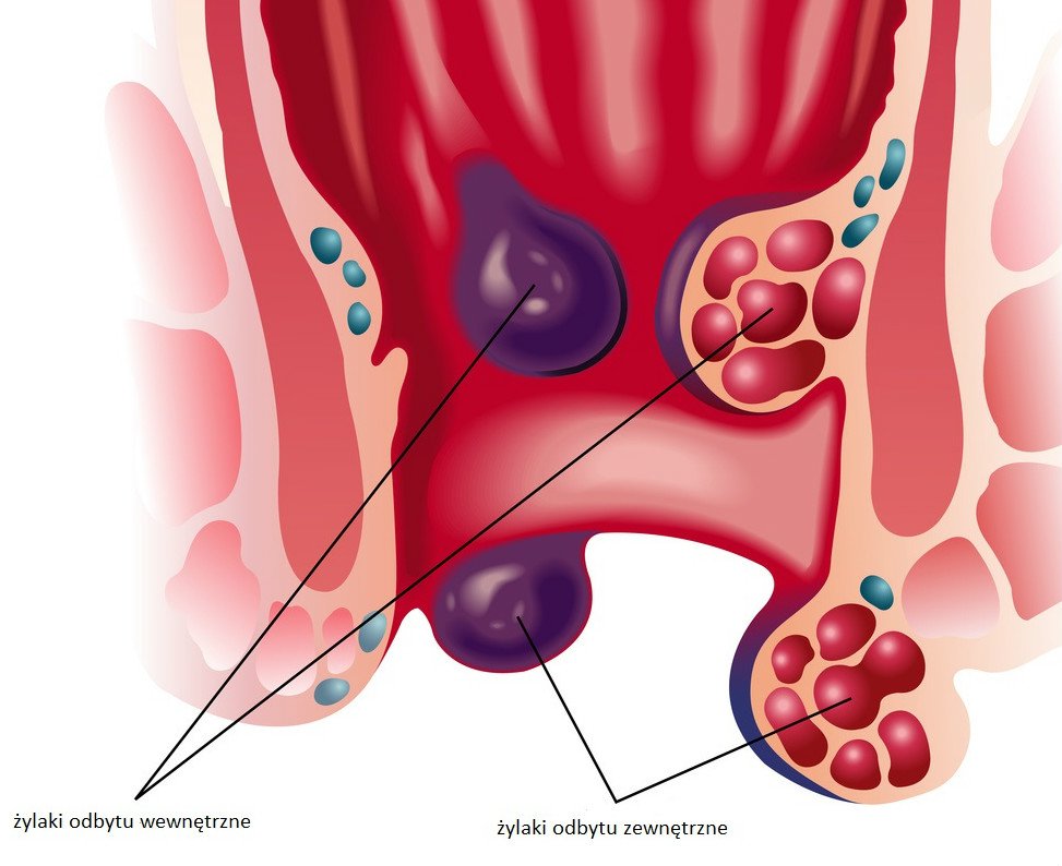 Боль в заднем проходе при беременности. Наружный геморрой 3 степени. Внутренний тромбированный геморрой. Тромбированный наружный геморроидальный узел.