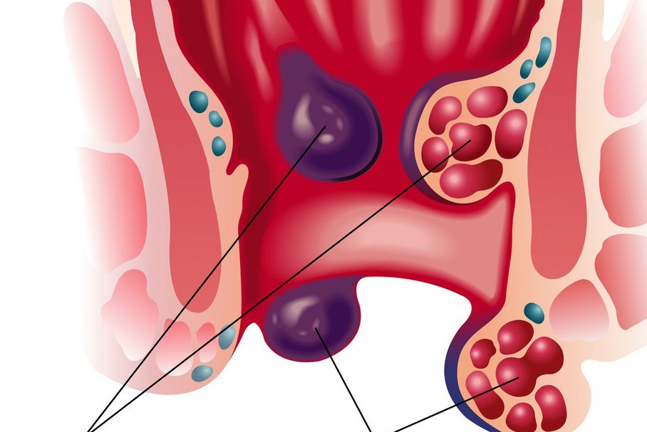 Wewnętrzne żylaki odbytu – hemoroidy wewnętrzne