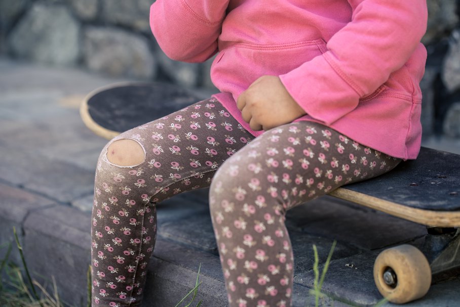 Siniaki na nogach – skąd się biorą, jakie są przyczyny i jak leczyć sińce na nogach?