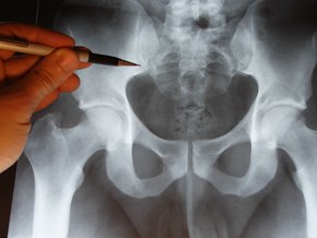 Jak leczyć złamanie szyjki kości udowej?