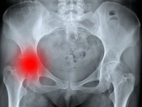 Zwichnięcie stawu biodrowego – jak się leczy zwichnięcie biodra?