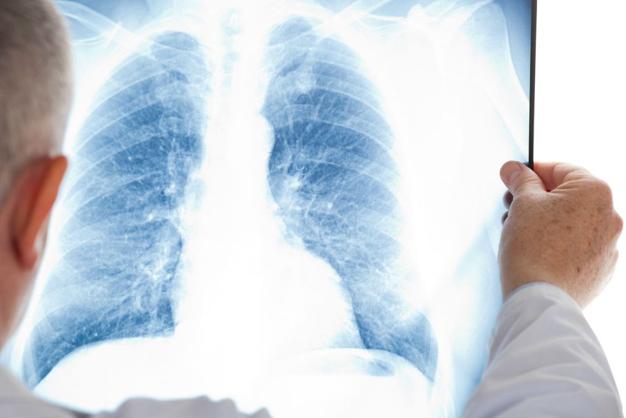 Zachłystowe zapalenie płuc – przyczyny, objawy, diagnostyka, leczenie