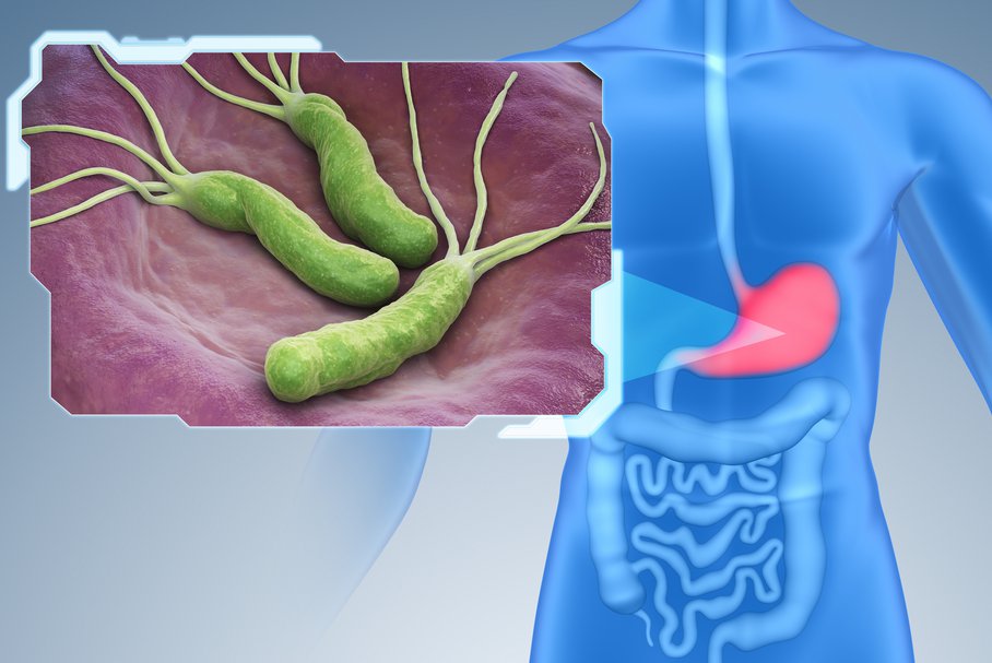 Helicobacter pylori – czym są, co wywołują, objawy, leczenie, testy serologiczne