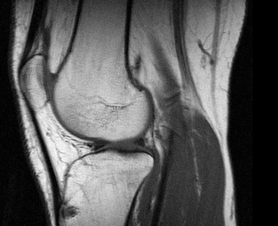 Zerwanie więzadła w kolanie – przyczyny, objawy, leczenie