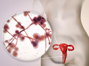 Candida glabrata objawy i leczenie