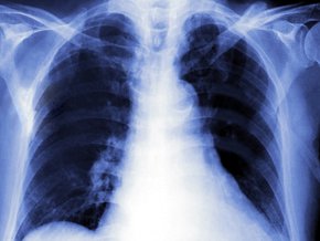 Bakterie z rodzaju Mycoplasma przyczyną zapalenia płuc